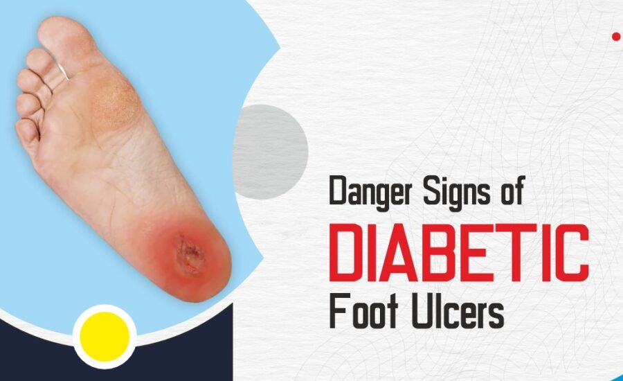 Diabetic Foot Ulcer Treatment – What You Need to Know ? - The Health Expert